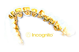 Брекеты Инкогнито (Incognito)